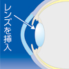 遠近両用白内障手術 (遠近両用眼内レンズ)